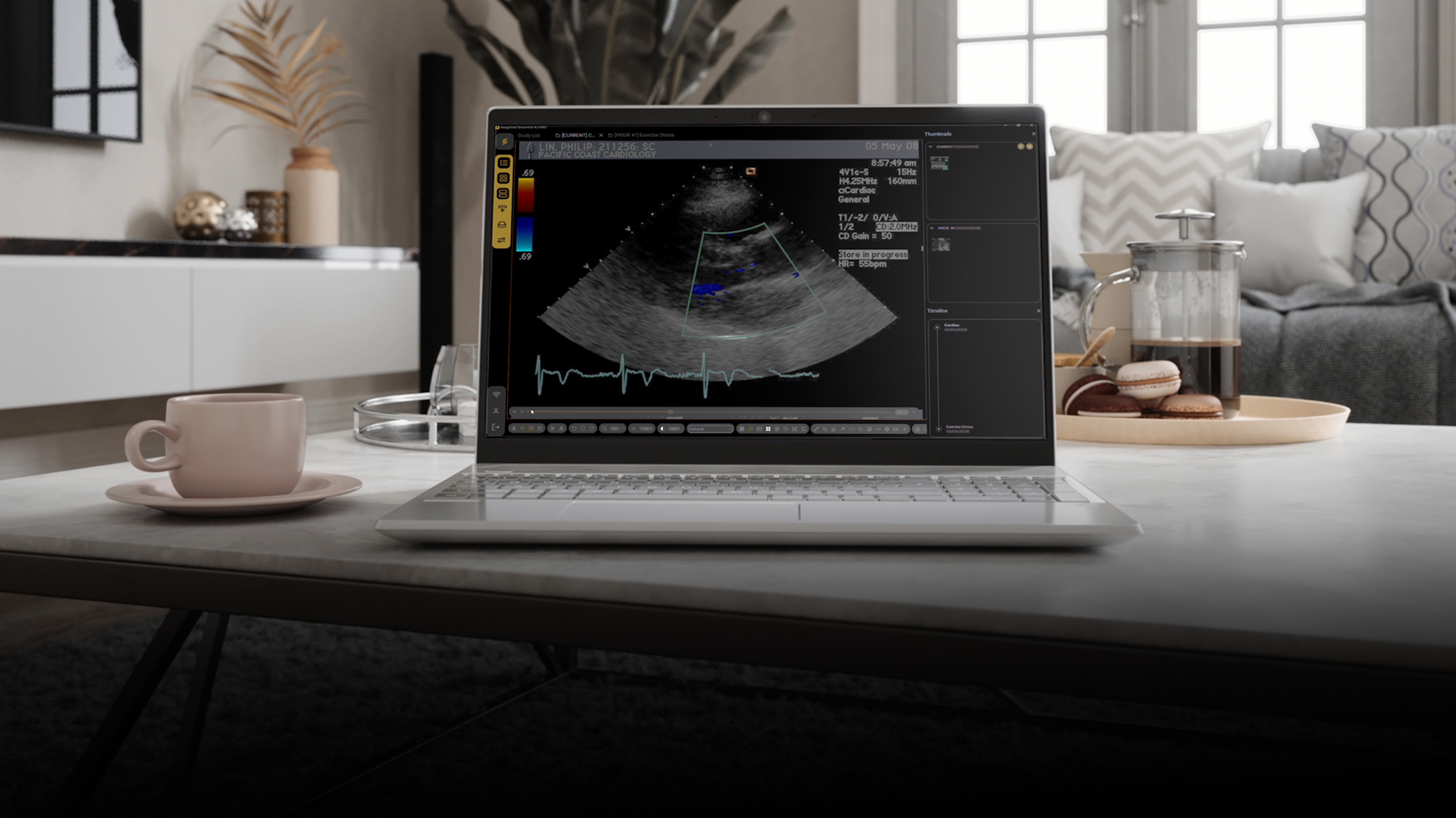 StreamVue viewer running on a laptop, reviewing a cardiac ultrasound study