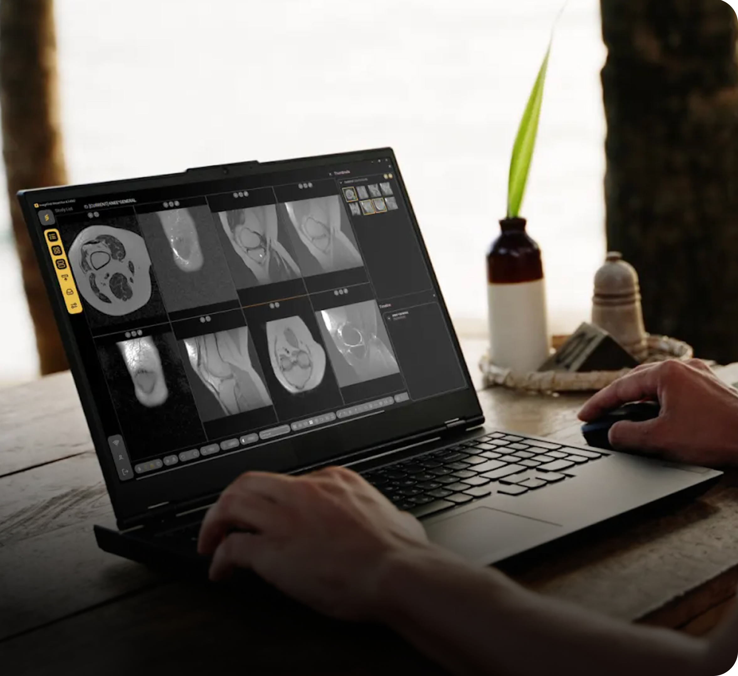 Radiologist reading a knee MRI in StreamVue on a laptop away from the hospital